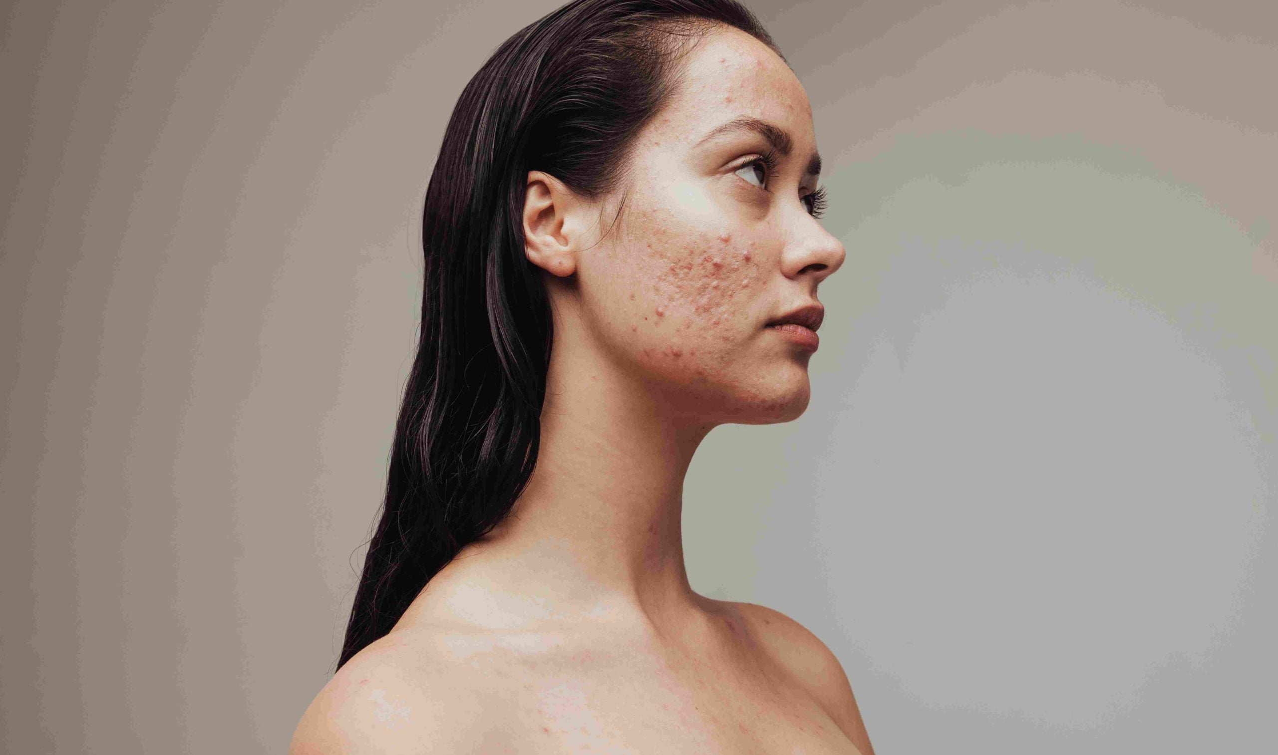 A Woman with Sad by acne on her face | Acne + Acne Scarring | Avail Aesthetics in Cary, Raleigh & Wake Forest, NC