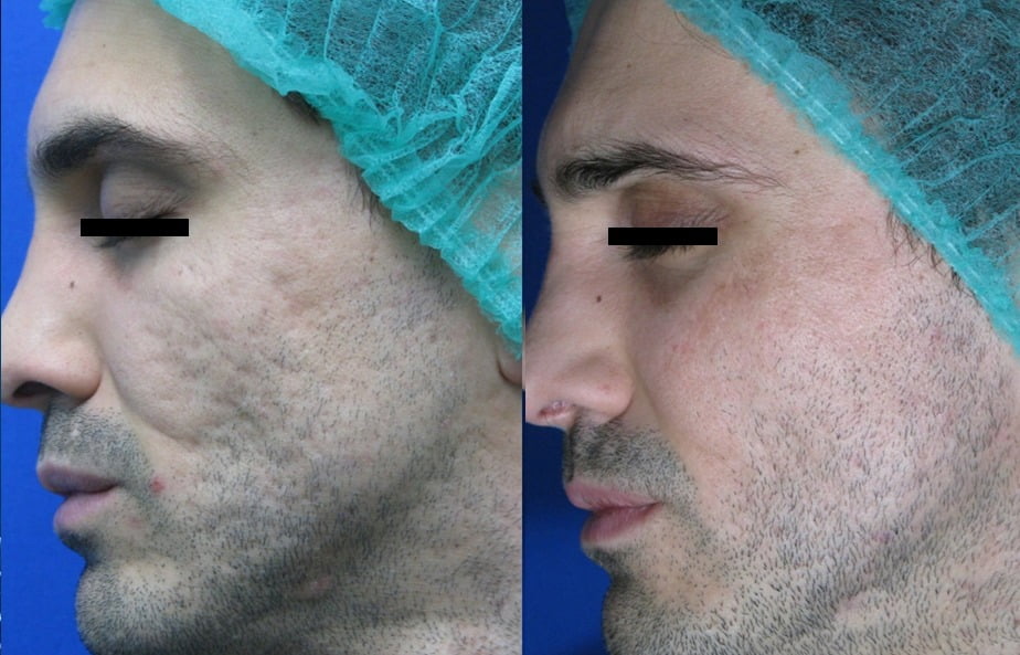 Acne-scars-BA_Courtesy-of-Prof.-G.Cannarozzo-Dermatology-Dept.-Tor-Vergata-University-Rome-Italy