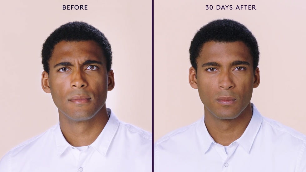Male Facial Rejuvenation | Before and After BOTOX® Cosmetic | wrinkle filler | Face | | Avail Aesthetics in Cary, Raleigh & Wake Forest, NC