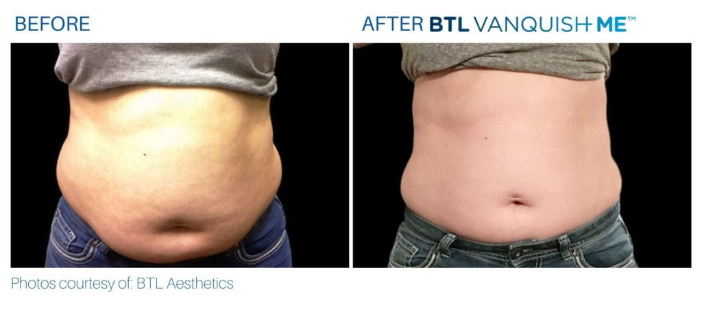 Before & After Vanquish Me Fat Reduction treatment results | Avail Aesthetics in Cary, Raleigh & Wake Forest, NC