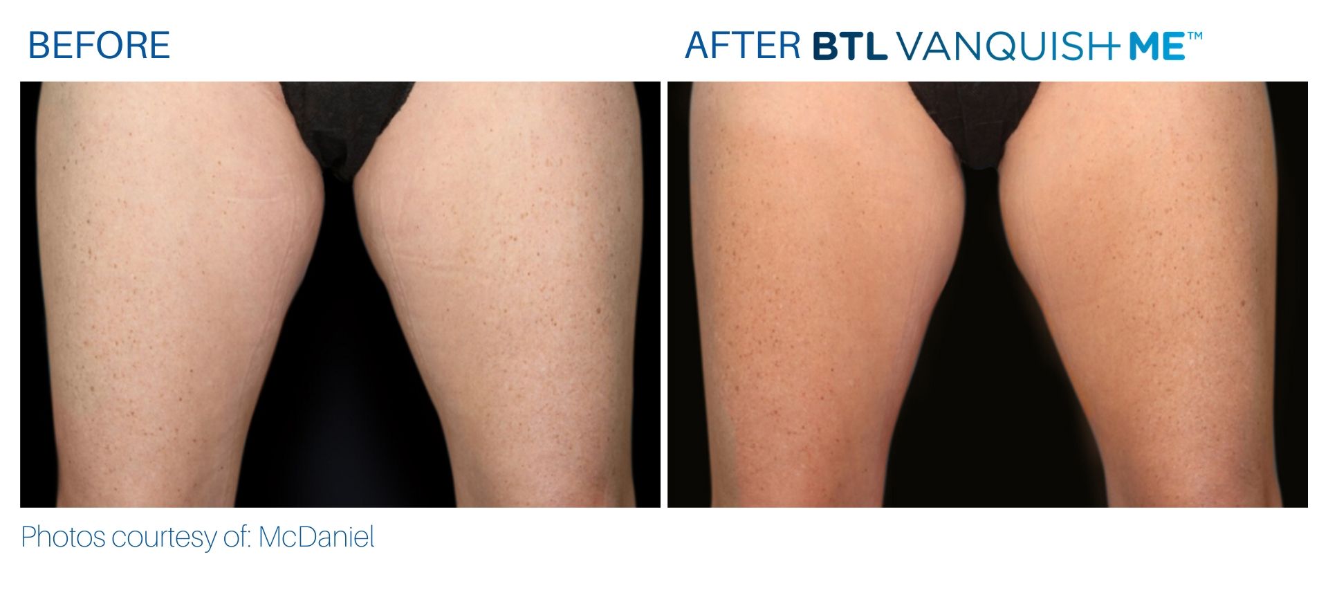 Before & After Vanquish Me Fat Reduction treatment results | Avail Aesthetics in Cary, Raleigh & Wake Forest, NC