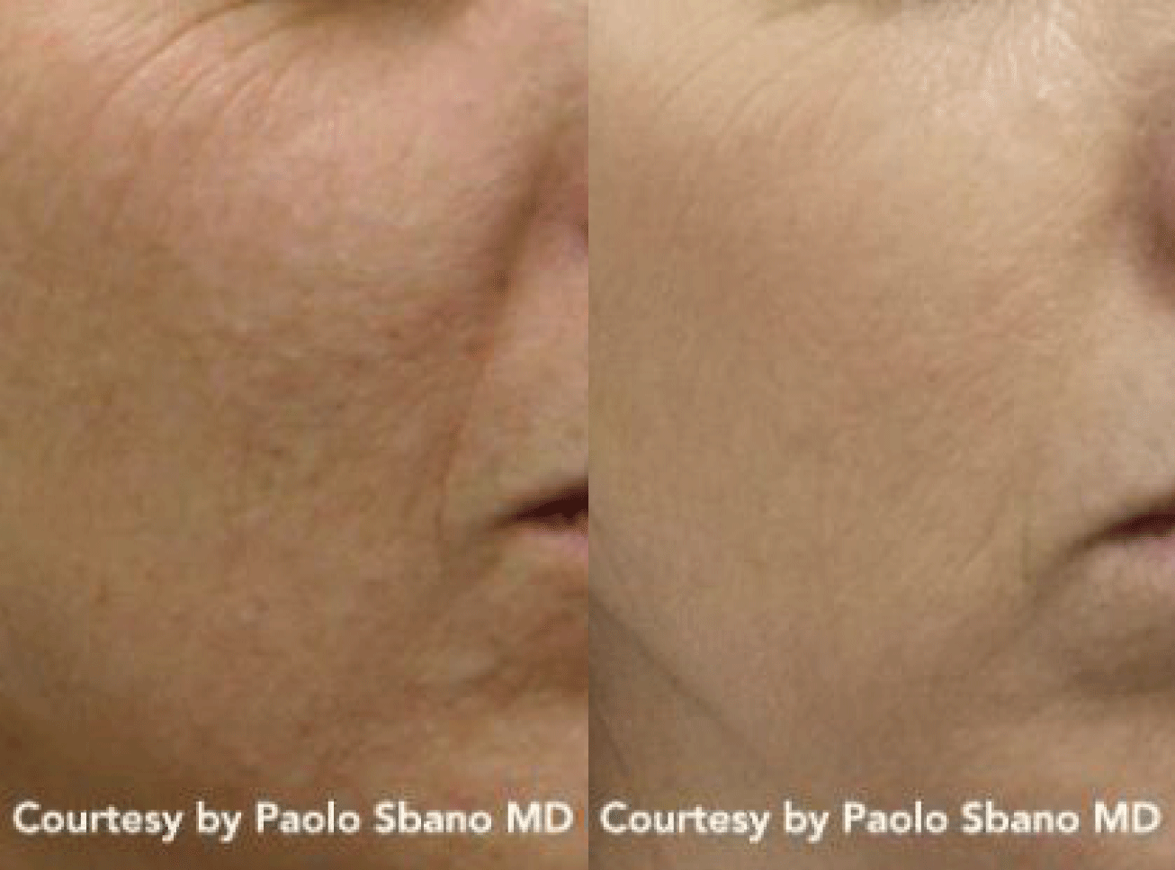 Discovery PICO Treatment Before & After Image | Avail Aesthetics in NC