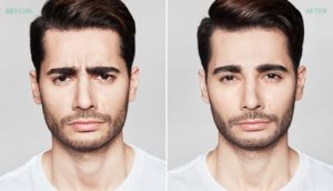 Male Facial Rejuvenation | Before and After Dysport® | wrinkle filler | Face | | Avail Aesthetics in Cary, Raleigh & Wake Forest, NC