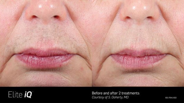 Elite iQ Before & After Lip Image | Avail Aesthetics in NC