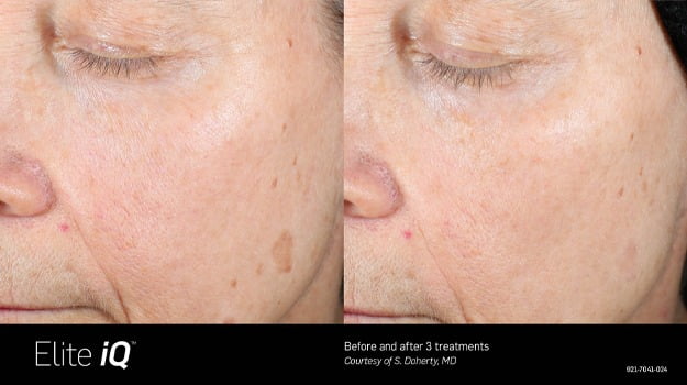Elite iQ Before & After Face Image | Avail Aesthetics in NC