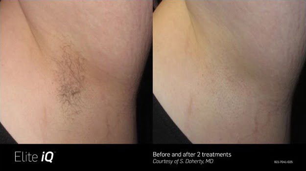 Elite iQ Before & After Image | Avail Aesthetics in NC