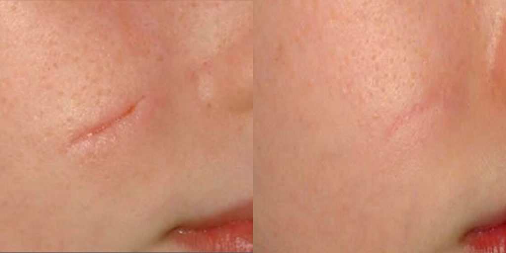 Before & After ICON Treatment Image | Avail Aesthetics in NC