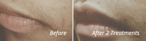 Before & After Motus AZ+ Treatment Image | Avail Aesthetics in NC