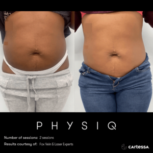 Before & After Image of PHYSIQ Body Contouring | Avail Aesthetics in Wake Forest, NC