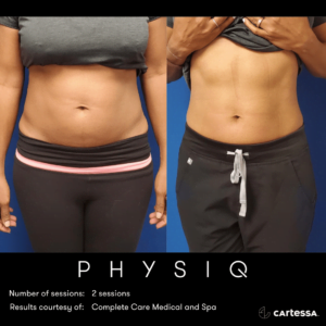 PHYSIQ Body Contouring Before & After Image | Avail Aesthetics in NC