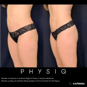 Before & After Image of PHYSIQ Body Contouring | Avail Aesthetics in Wake Forest, NC