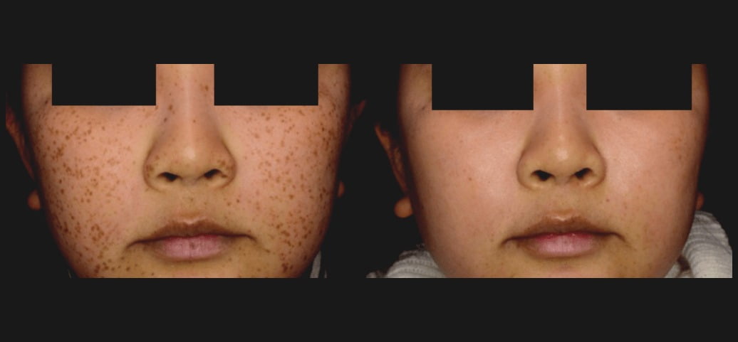 Before & After PicoSure Skin Revitalization Treatment Image | Avail Aesthetics in NC