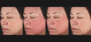 Before & After PicoSure Skin Revitalization Treatment Image | Avail Aesthetics in NC