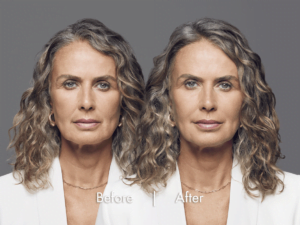 Female Facial Rejuvenation | Before and After RHA® Fillers | wrinkle filler | Face | | Avail Aesthetics in Cary, Raleigh & Wake Forest, NC