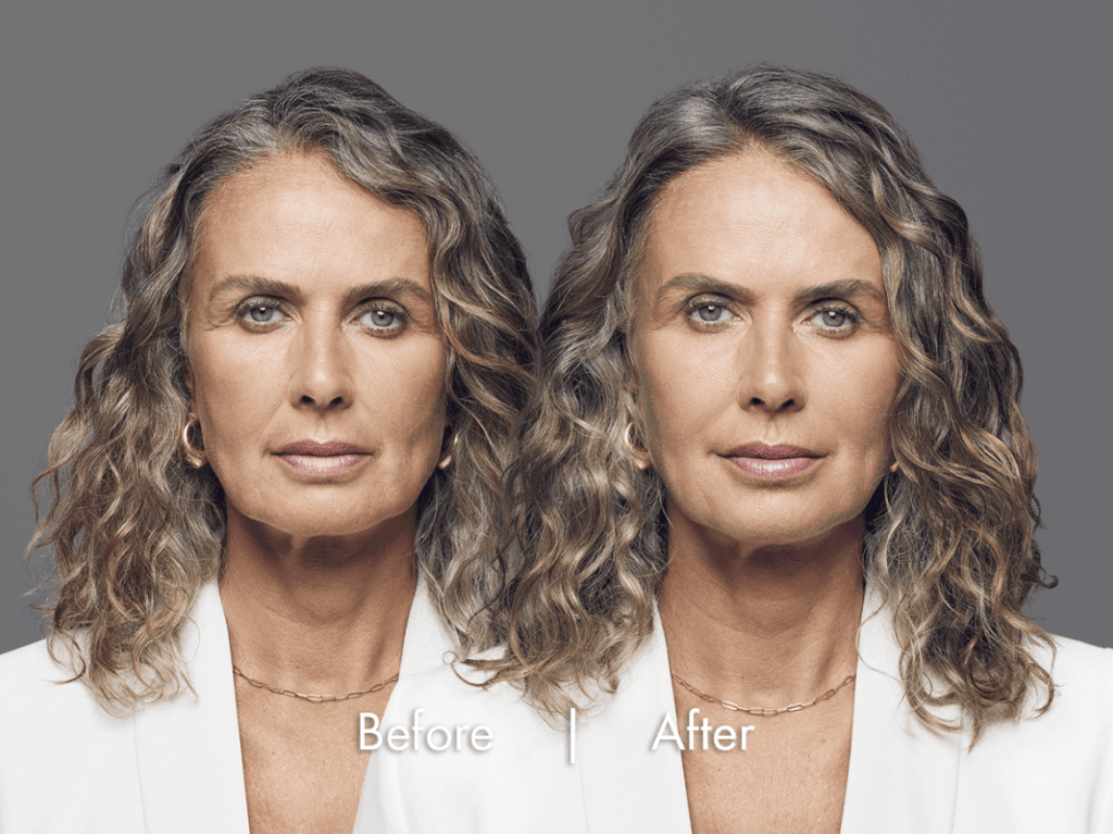 Female Facial Rejuvenation | Before and After RHA® Fillers | wrinkle filler | Face | | Avail Aesthetics in Cary, Raleigh & Wake Forest, NC