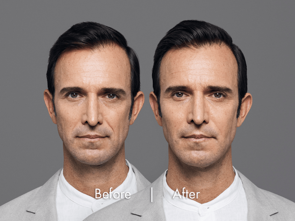 Male Facial Rejuvenation | Before and After RHA® Fillers | wrinkle filler | Face | | Avail Aesthetics in Cary, Raleigh & Wake Forest, NC