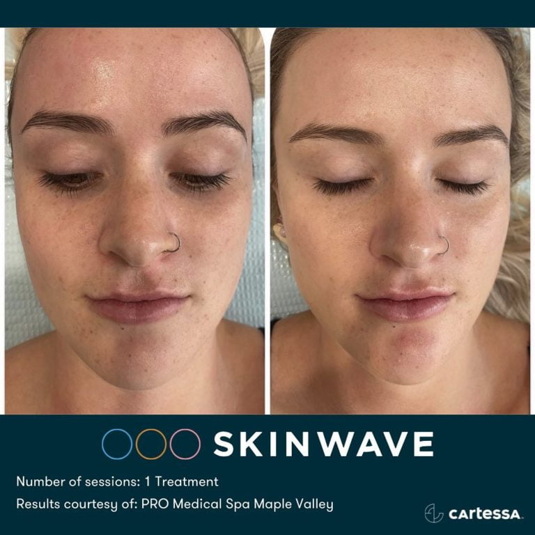 Young Girl Before & After Skinwave Treatment | Avail Aesthetics in Wake Forest, NC