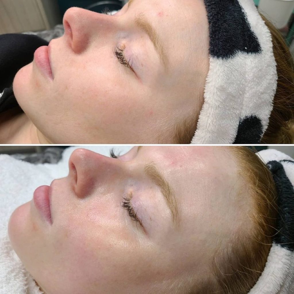 Young Girl Before & After Skinwave Treatment | Avail Aesthetics in Wake Forest, NC