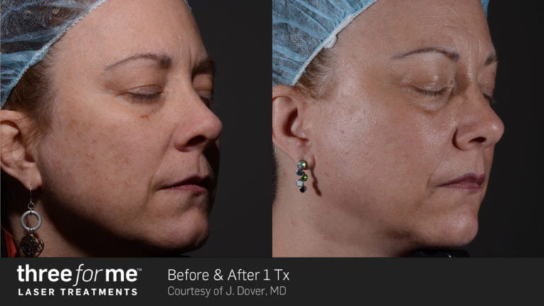 Before & After Image of ThreeforMe Treatment | Avail Aesthetics in Wake Forest, NC