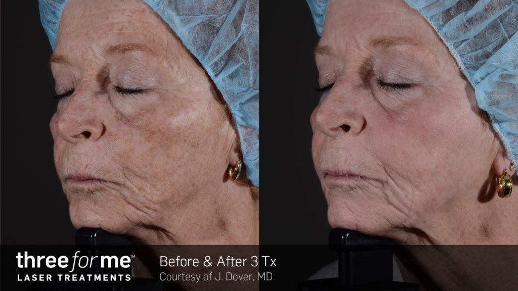 Before & After Image of ThreeforMe Treatment | Avail Aesthetics in Wake Forest, NC