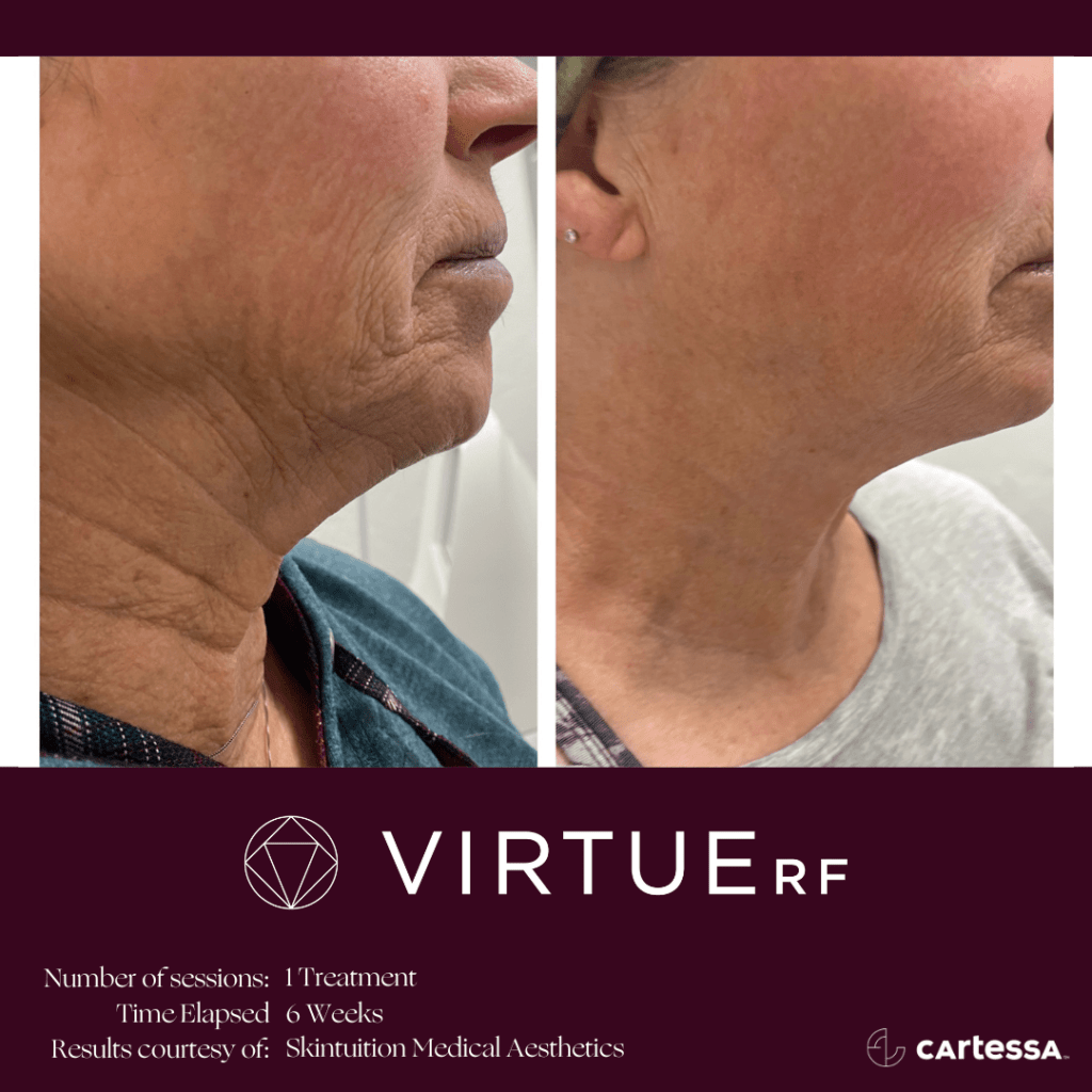 Before & After Image of VirtueRF Microneedling Treatment | Avail Aesthetics in Wake Forest, NC