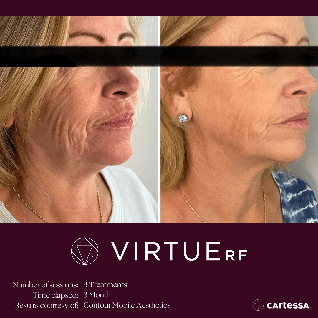 Before & After Image of VirtueRF Microneedling Treatment | Avail Aesthetics in Wake Forest, NC