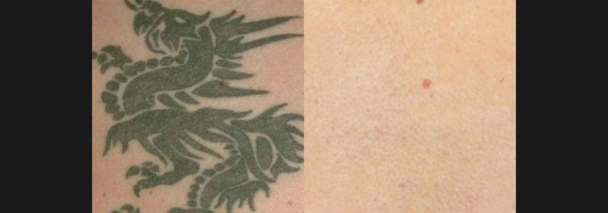Before & After Image of PicoSure Tattoo Removal | Avail Aesthetics in NC
