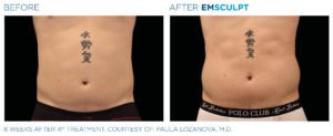 Before & After Image of Emsculpt Body Sculpting Treatment | Avail Aesthetics in Wake Forest, NC