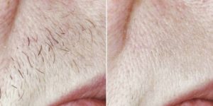 Laser Hair Removal Before & After Image | Avail Aesthetics in NC