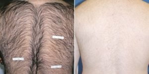 Before & After Image of Laser Hair Removal Treatment | Avail Aesthetics in Wake Forest, NC