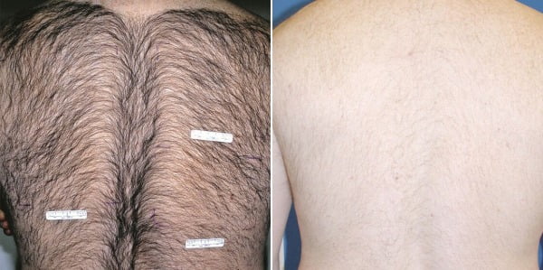 Before & After Image of Laser Hair Removal Treatment | Avail Aesthetics in Wake Forest, NC
