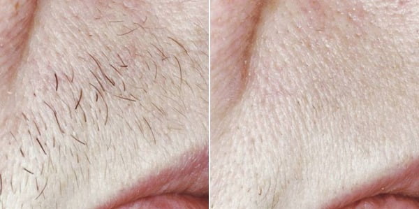 Laser Hair Removal Before & After Image | Avail Aesthetics in NC