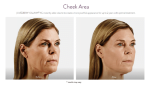 Before and After Juvederm Treatment result of Female - Cheek Area | Avail Aesthetics in Cary, Raleigh & Wake Forest, NC
