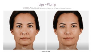 Before and After Juvederm Treatment result of Female - Lip Plump | Avail Aesthetics in Cary, Raleigh & Wake Forest, NC