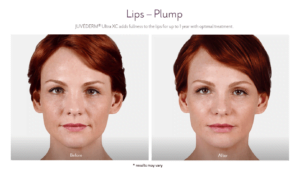 Before and After Juvederm Treatment result of Female - Lip Plump | Avail Aesthetics in Cary, Raleigh & Wake Forest, NC