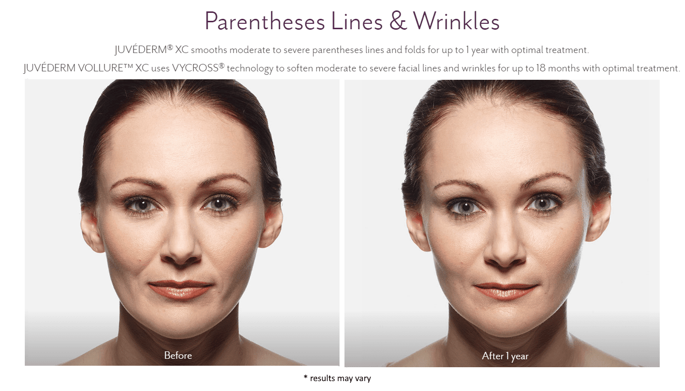 Before and After Juvederm Treatment result of Female - Parentheses Lines & Wrikles | Avail Aesthetics in Cary, Raleigh & Wake Forest, NC