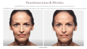 juvederm-before-and-after-f