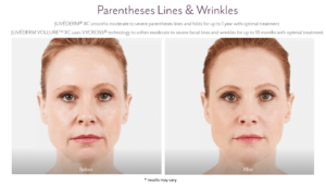 juvederm-before-and-after-g