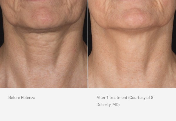 Before & After Potenza™ RF Microneedling Treatment Image | Avail Aesthetics in NC