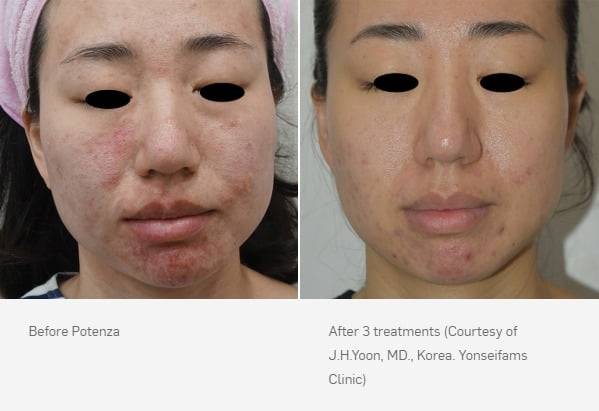 Before & After Potenza™ RF Microneedling Treatment Image | Avail Aesthetics in NC