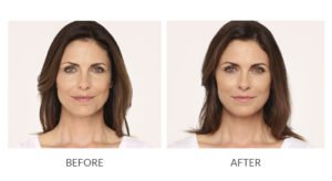 Female Facial Rejuvenation | Before and After Radiesse | wrinkle filler | Face | | Avail Aesthetics in Cary, Raleigh & Wake Forest, NC