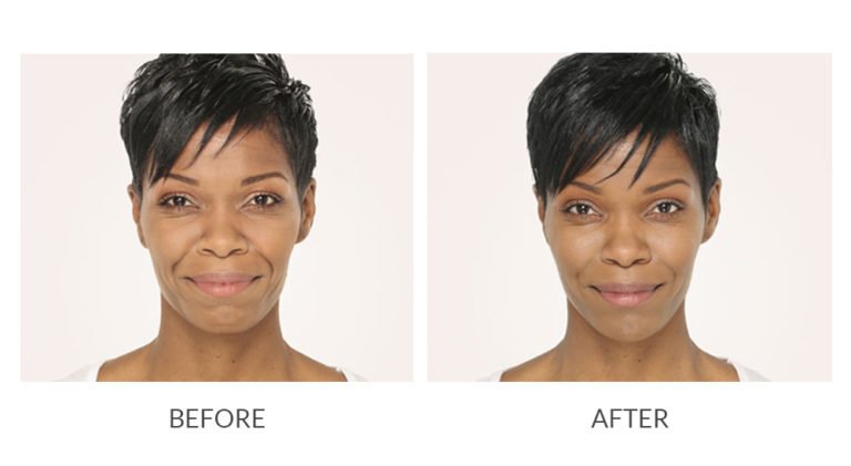 Female Facial Rejuvenation | Before and After Radiesse | wrinkle filler | Face | | Avail Aesthetics in Cary, Raleigh & Wake Forest, NC