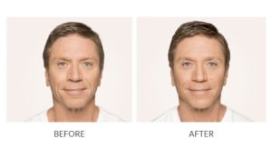 Male Facial Rejuvenation | Before and After RADIESSE | wrinkle filler | Face | | Avail Aesthetics in Cary, Raleigh & Wake Forest, NC