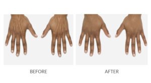 Hand Rejuvenation | Before and After RADIESSE | wrinkle filler | Hand | | Avail Aesthetics in Cary, Raleigh & Wake Forest, NC
