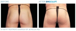 Before & After Image of Emsculpt Body Sculpting Treatment | Avail Aesthetics in Wake Forest, NC
