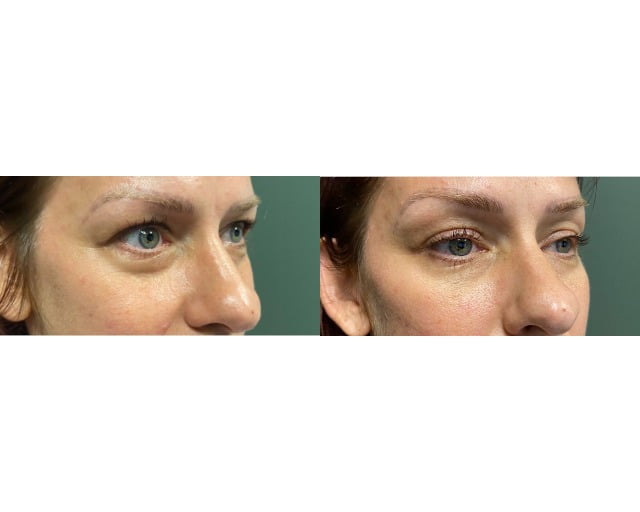 subnovii Treatment Woman Before & After Image | Avail Aesthetics in Wake Forest, NC
