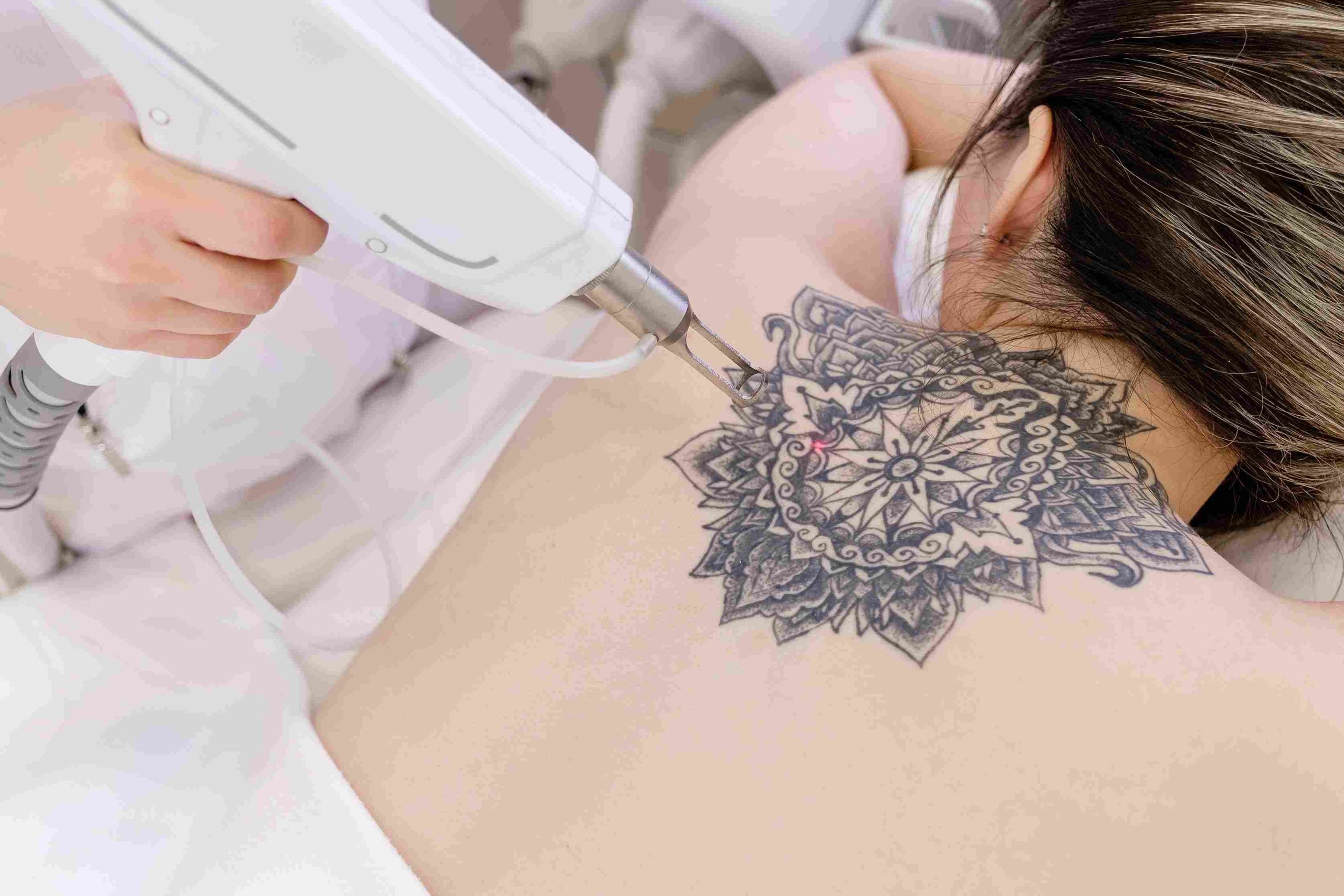 Portrait of a woman getting tattoo removal laser treatment on her back | Avail Aesthetics in Cary, Raleigh & Wake Forest, NC