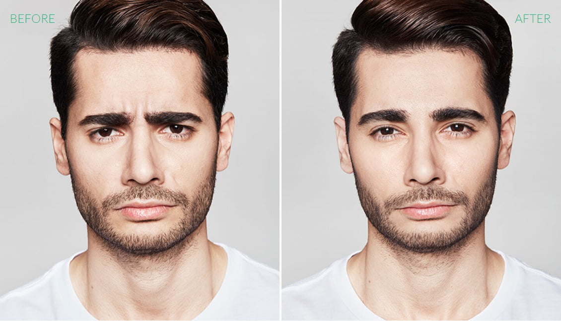 Man Before & After Image | Avail Aesthetics in Wake Forest, NC