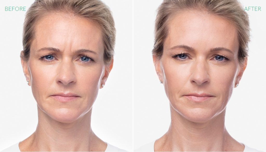 Dysport Treatment Woman Before & After Image | Avail Aesthetics in Wake Forest, NC