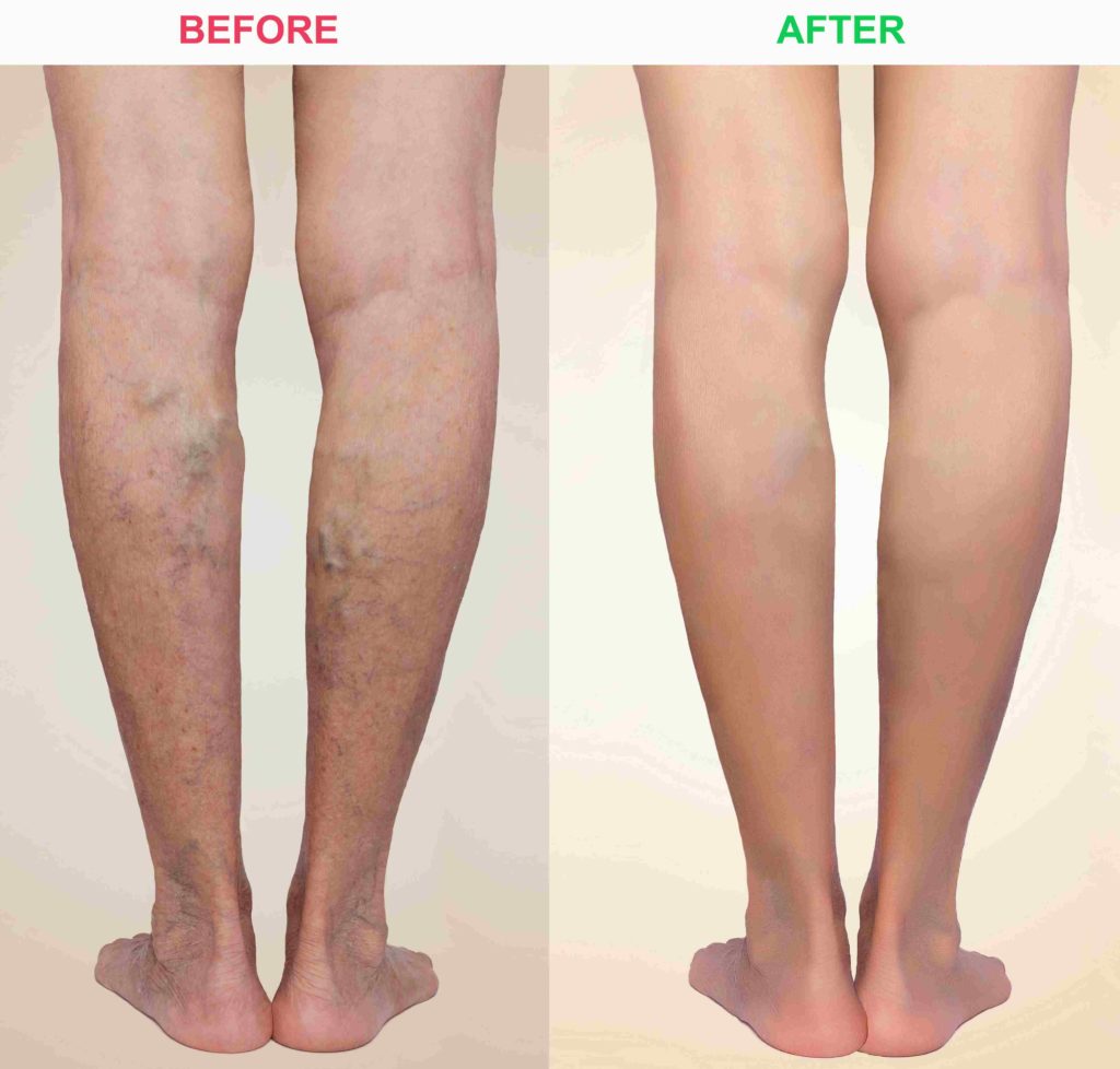 Laser Vein Removal in North Carolina